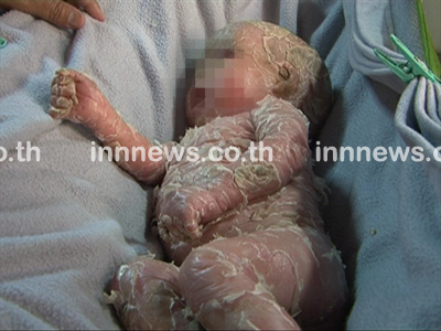 โรคดักแด้