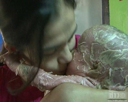 โรคดักแด้