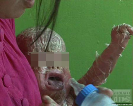 โรคดักแด้