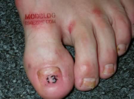 รอยสักใต้เล็บเท้า