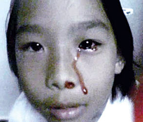 เหงื่อออกเป็นเลือด