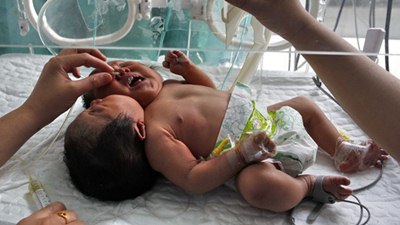 เด็กทารกแฝด