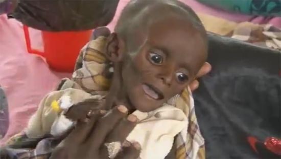 เผยภาพสุดสลด เด็กน้อยผอมโกรกใกล้ตายในเคนย่า