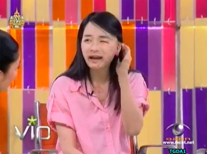 น้องเค้ก เหยื่อน้ำกรด