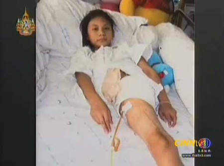 น้องกุ๊กกิ๊ก หนูน้อยกำลังใจเกินร้อย แม้โดนรถหกล้อทับจนเสียขาไป