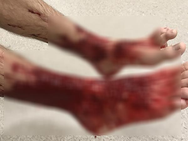 แมลงกัด