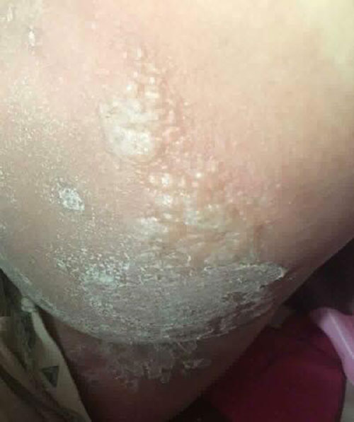 ครีมแก้ก้นดำ