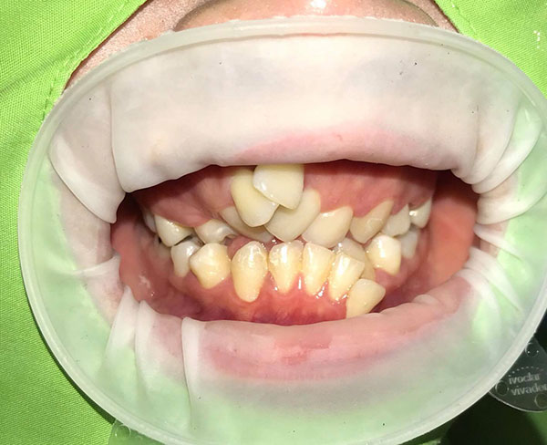 จัดฟันแฟชั่น