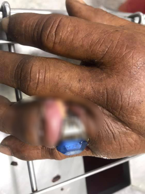 นิ้วติดแหวน