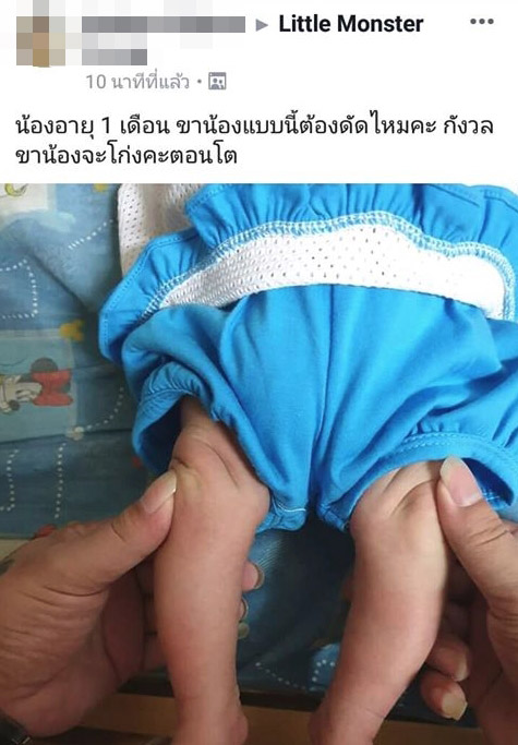 ดัดขาเด็ก
