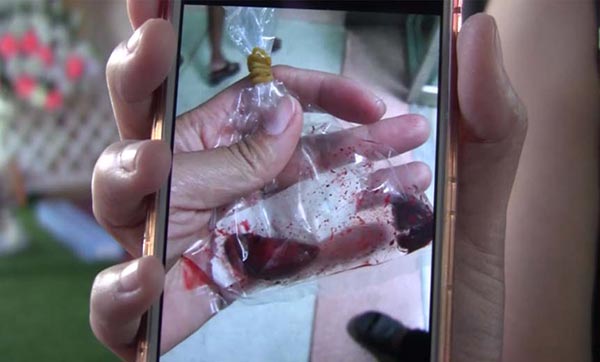 กินเมล็ดกระท้อนบาดลำไส้ตาย