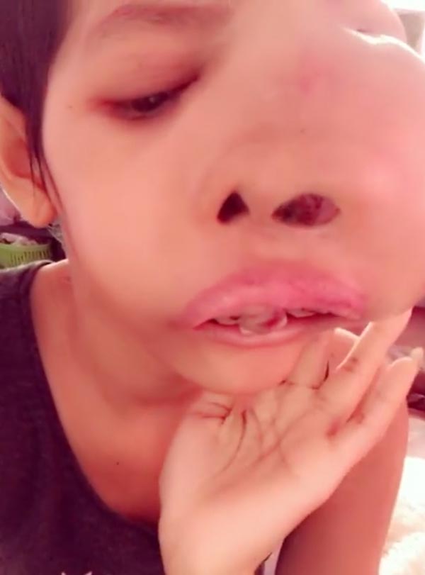 ป่วยมะเร็งจนหน้าบวม