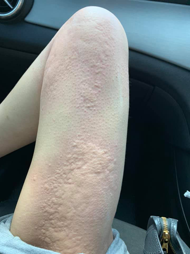 แพ้ไข่หอยเม่น