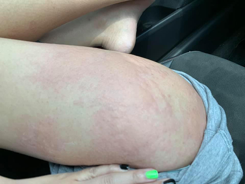 แพ้ไข่หอยเม่น