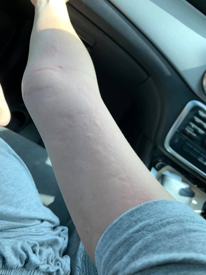 แพ้ไข่หอยเม่น