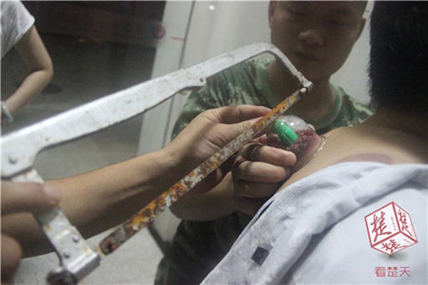 ครอบแก้วบำบัด