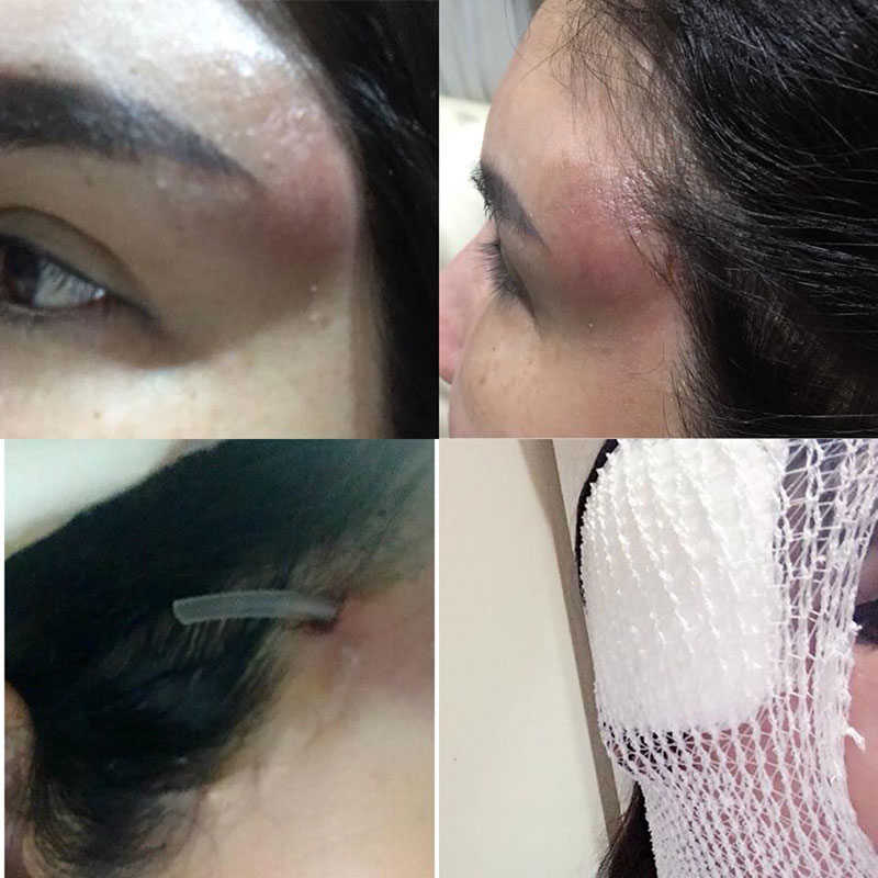 คลินิกฉีดสเตียรอยด์ รักษาสิว