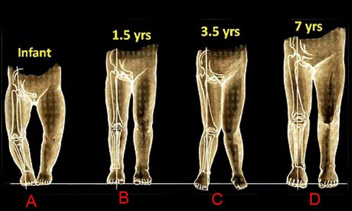 ดัดขาเด็ก
