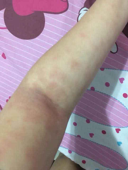 ครีมแก้ก้นดำ