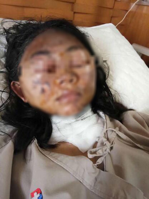 เตาโรงงานระเบิดใส่ นศ.