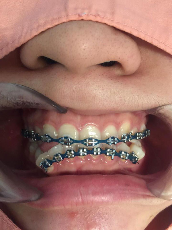 จัดฟันแฟชั่น