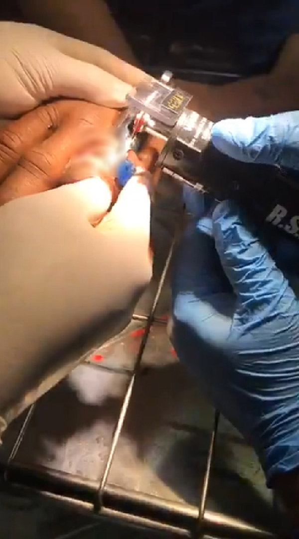 นิ้วติดแหวน