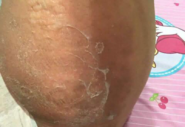 ครีมแก้ก้นดำ