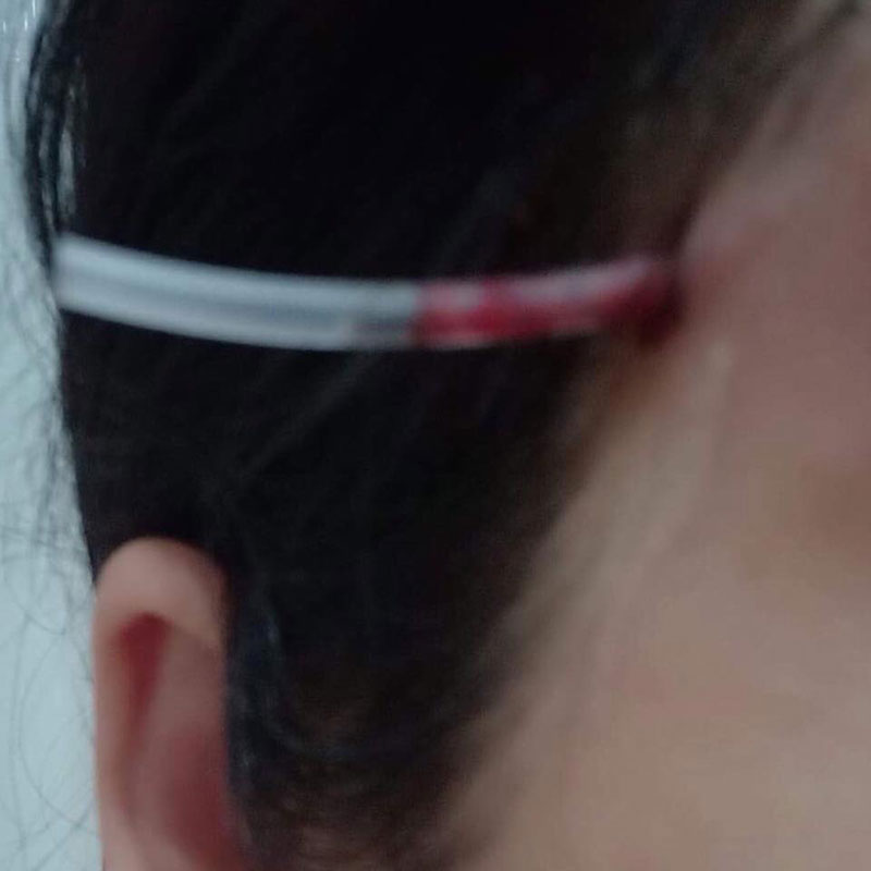 คลินิกฉีดสเตียรอยด์ รักษาสิว