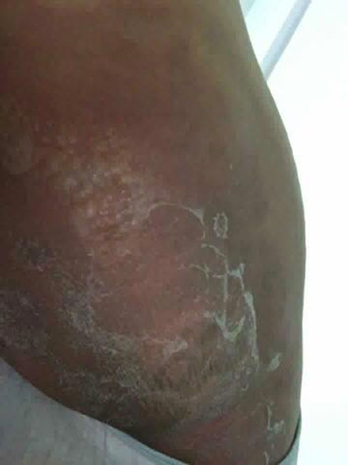 ครีมแก้ก้นดำ