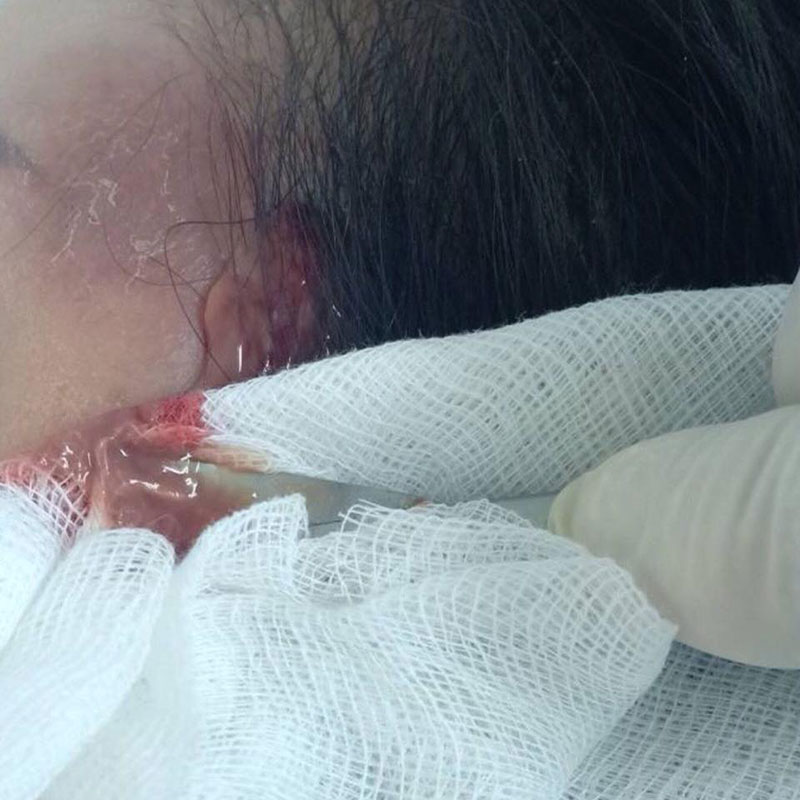 คลินิกฉีดสเตียรอยด์ รักษาสิว