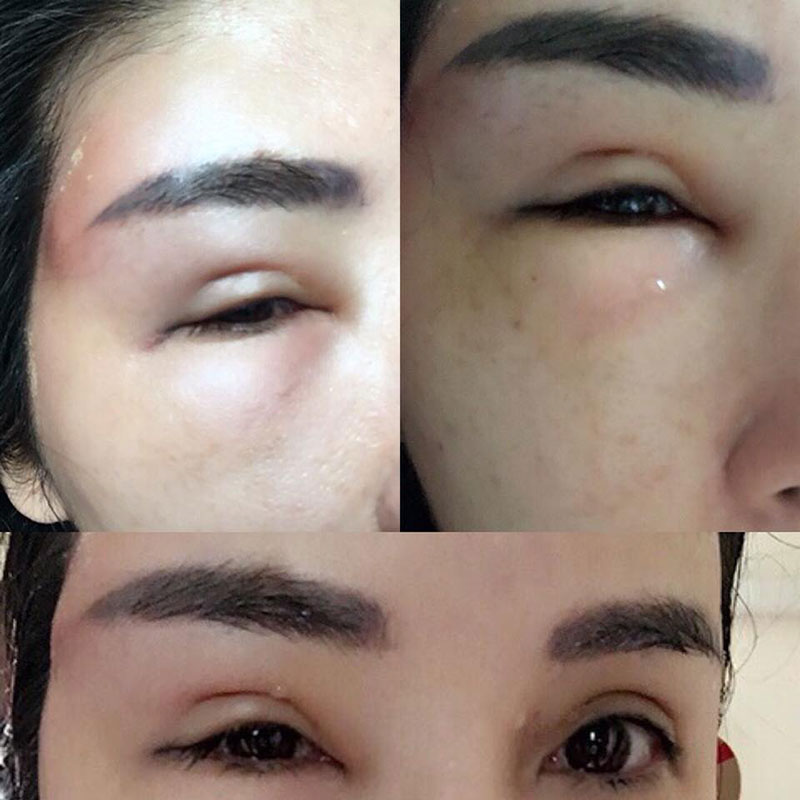 คลินิกฉีดสเตียรอยด์ รักษาสิว