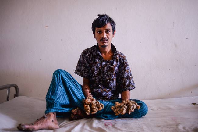 มนุษย์ต้นไม้ 