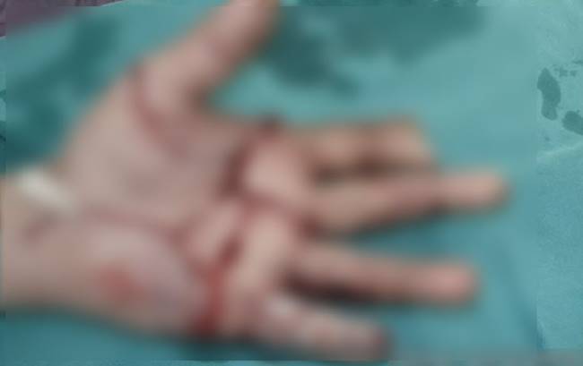 นิ้วขาด