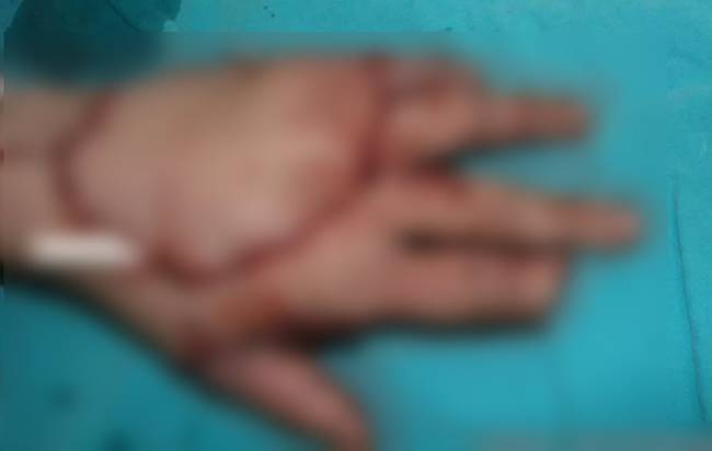 นิ้วขาด