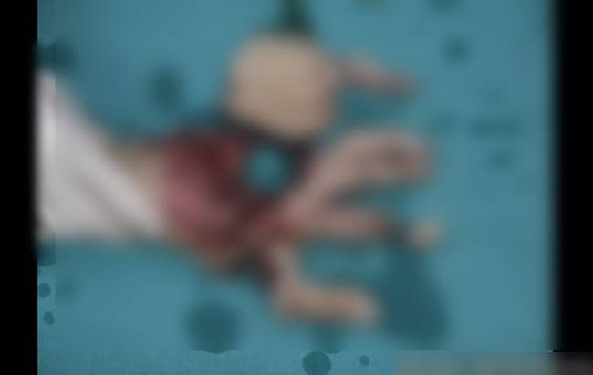 นิ้วขาด