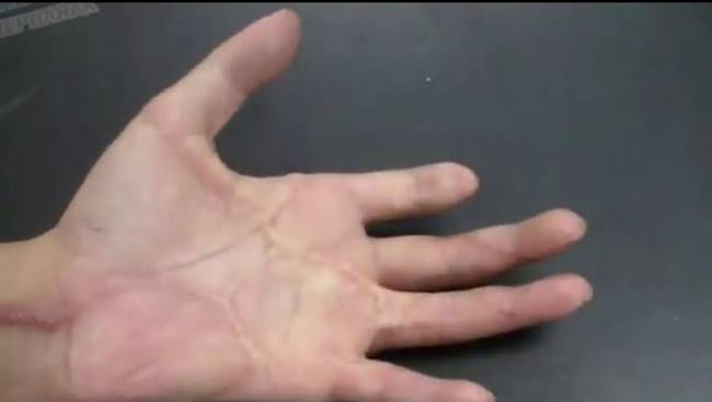 นิ้วขาด