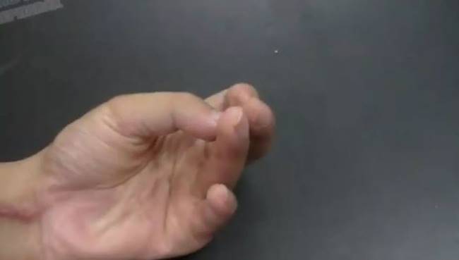 นิ้วขาด