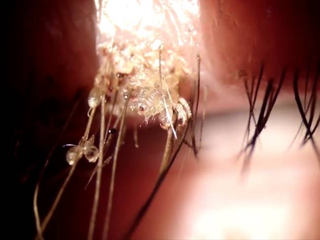 โลนเกาะขนตา