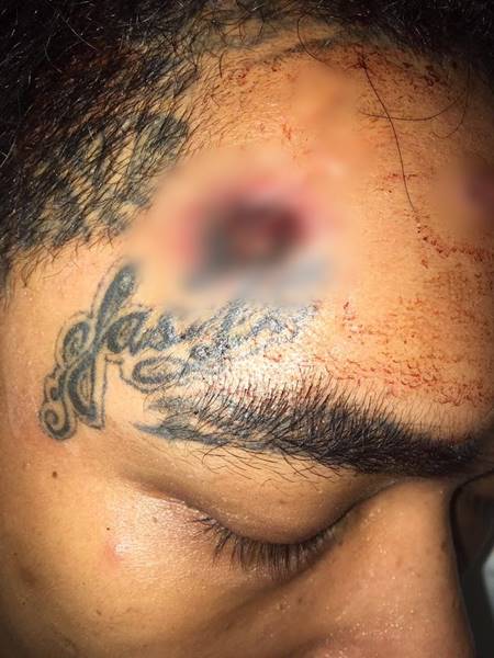 เน วัดดาว โพสต์หลังฟื้น โชว์ภาพแผลกลางขมับ ย้ำไม่ใช่เน็ตไอดอล