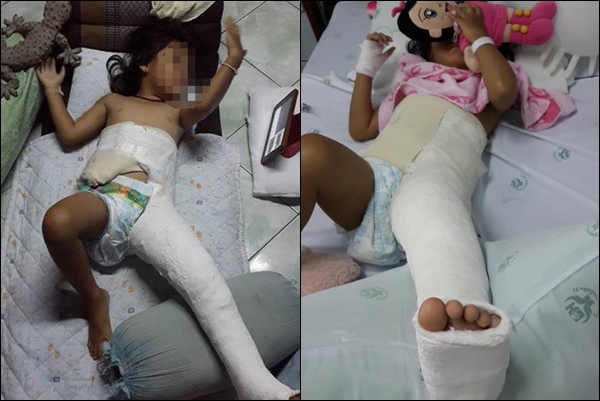 เล่นสไลเดอร์ที่สวนน้ำจนขาหัก