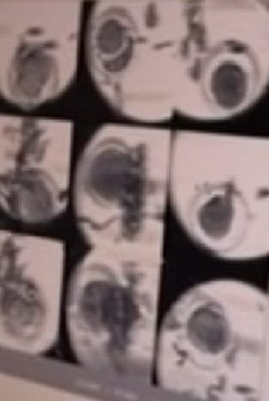 ตัดต่อพันธุกรรมทารก