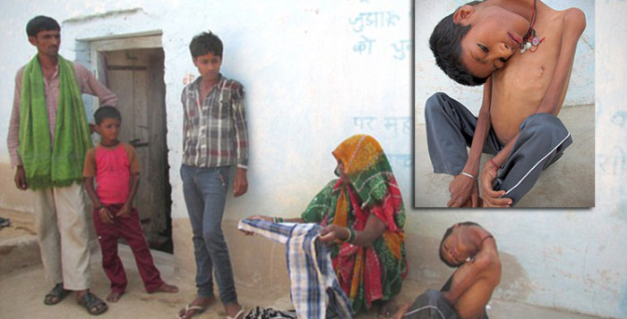 เด็กคอพับ