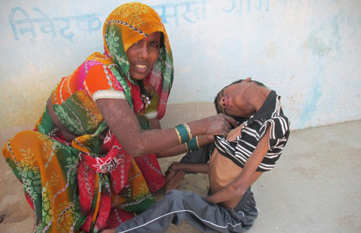 เด็กคอพับ