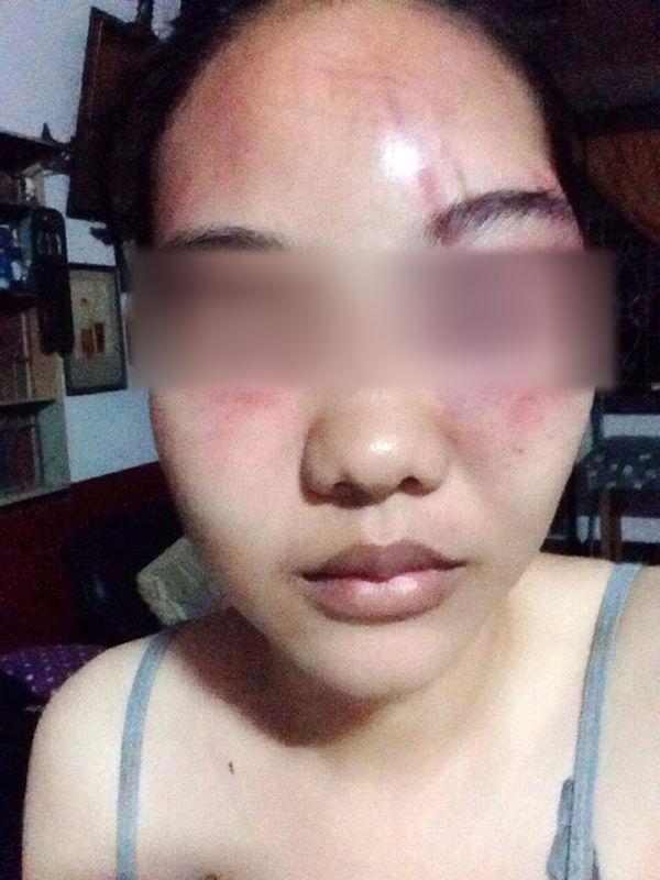 สาวถูกอาแท้ ๆ ใช้เตารีดทุบหน้า เหตุเถียงกันเรื่องกุญแจบ้าน