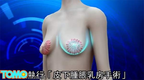 ยายวัย 70 เสริมหน้าอกให้กลมเด้ง ทนไม่ไหวถูกนินทาว่านมยาน 