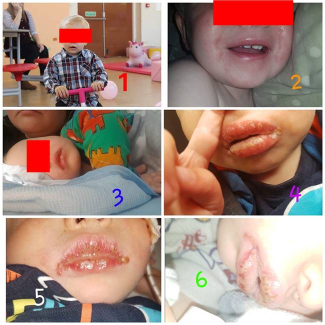 โรคในเด็ก