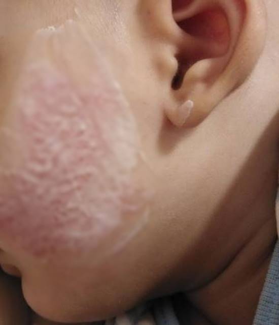 ภูมิแพ้ในเด็ก