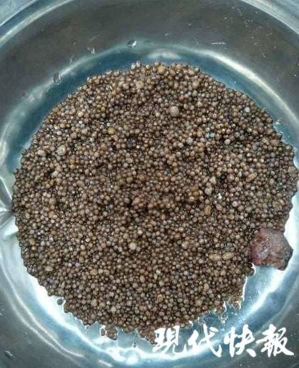 นิ่วในไต