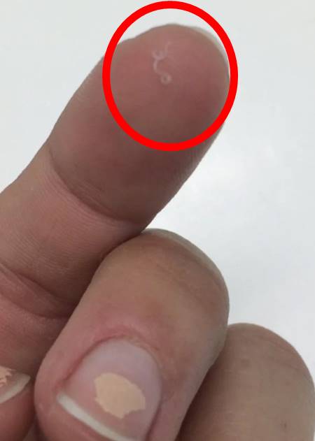 สาวพบพยาธิ 14 ตัวยั้วเยี้ยอยู่ในตา