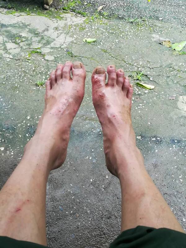 ทหารเท้าเปื่อย